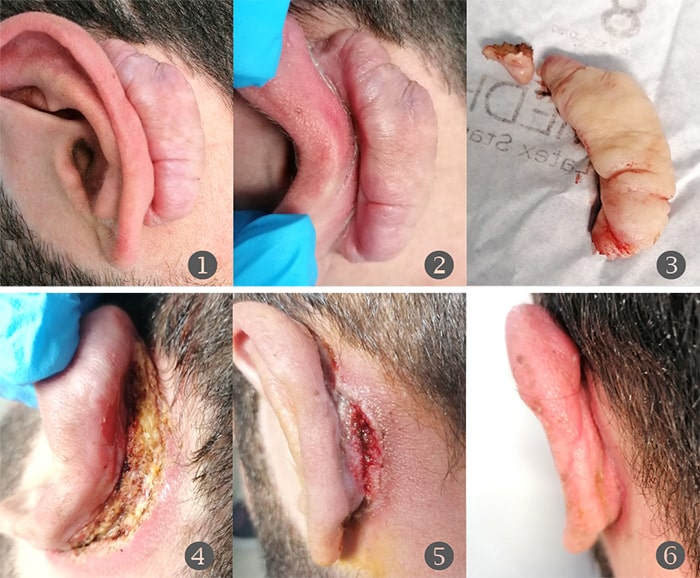 Asportazione cheloide orecchio post otoplastica