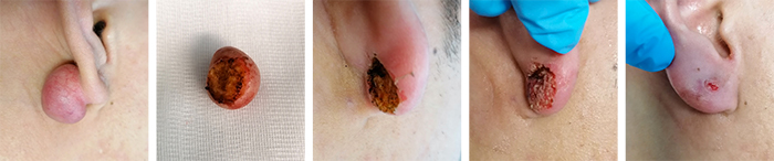 asportazione cheloide orecchio