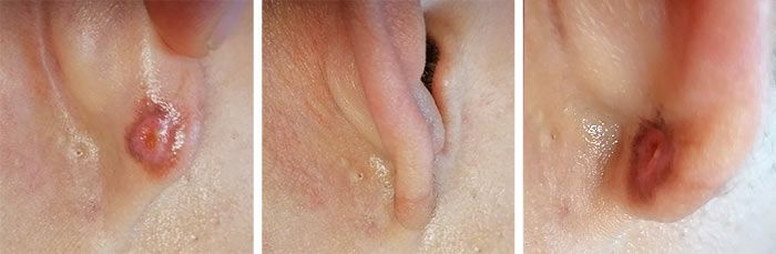 asportazione cheloide orecchio dopo un mese dalla asportazione