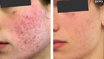 cicatrici da acne trattamento laser co2