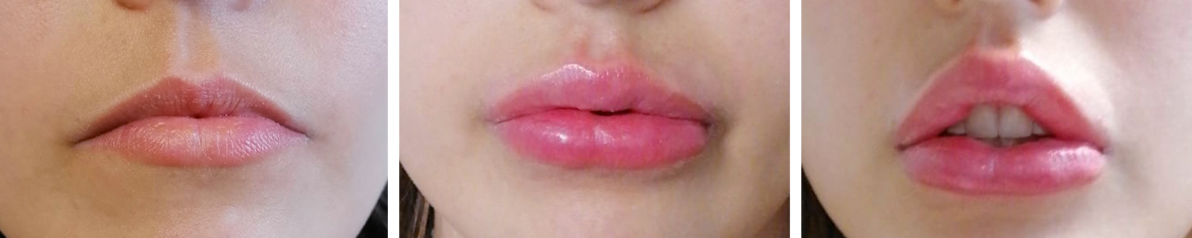 filler ialuronico riempimento aumento labbra